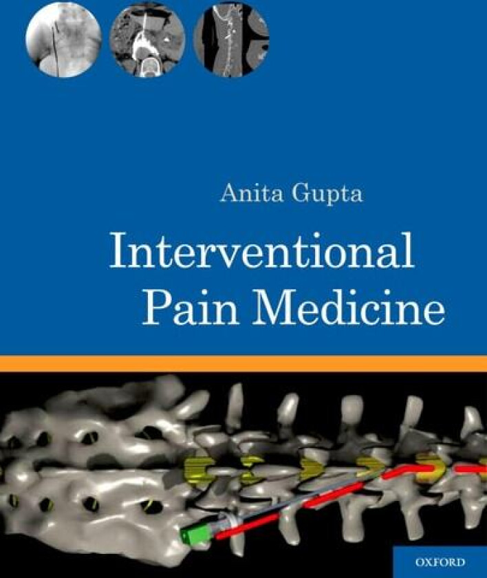 Interventional Pain Medicine av Anita Gupta (Spiral bound)