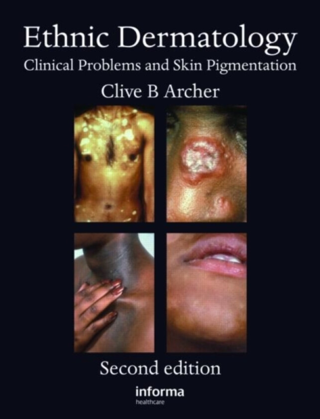Ethnic Dermatology av Clive B. Archer (Hardcover)