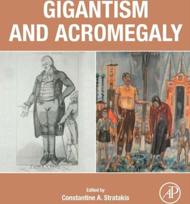 Gigantism and Acromegaly