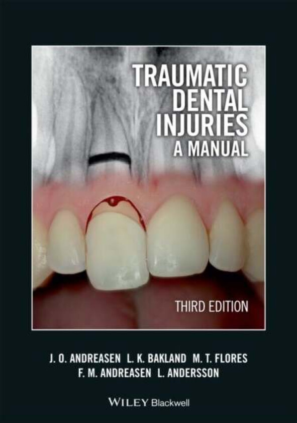 Traumatic Dental Injuries av Jens O. (University Hospital (Rigshospitalet) Copenhagen Denmark) Andreasen, Leif K. (Loma Linda University California US