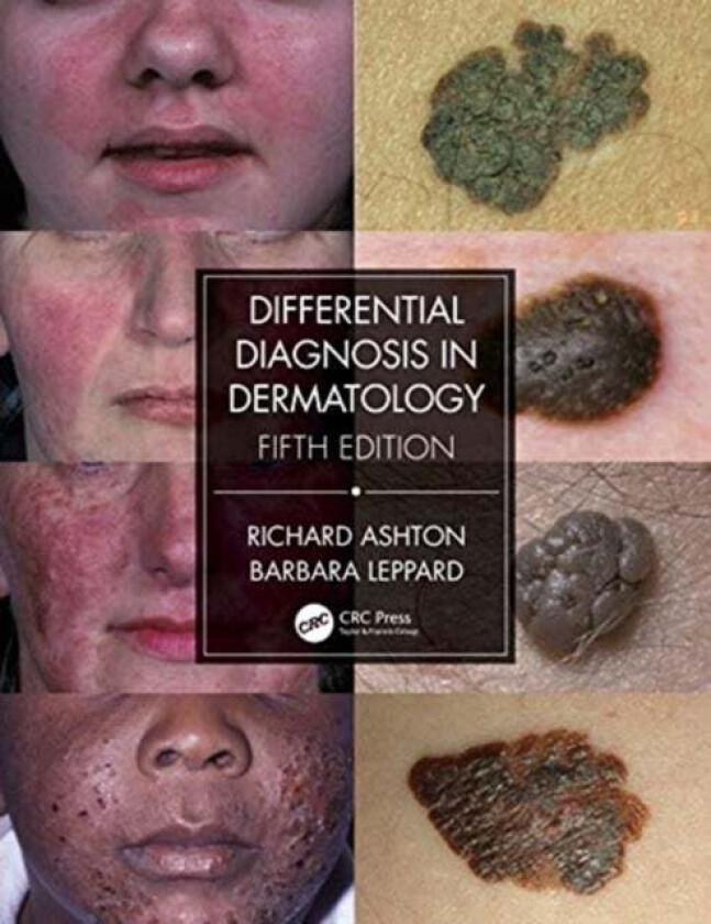 Differential Diagnosis in Dermatology av Richard Ashton, Barbara Leppard