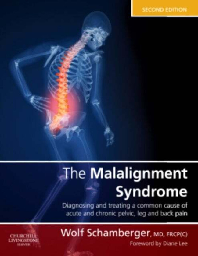 The Malalignment Syndrome av Wolf (Clinical Associate Professor Department of Medicine Division of Physical Medicine and Rehabilitation and The Allan