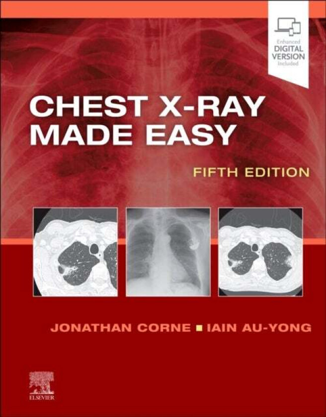 Chest X-Ray Made Easy av Jonathan MA PhD MB BS FRCP (Consultant Respiratory Physician Nottingham University Hospitals NHS Trust Nottingham Corne, Hea