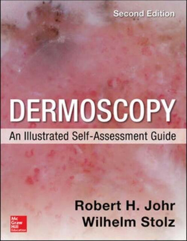 Dermoscopy: An Illustrated Self-Assessment Guide, 2/e av Robert Johr, Wilhelm Stolz