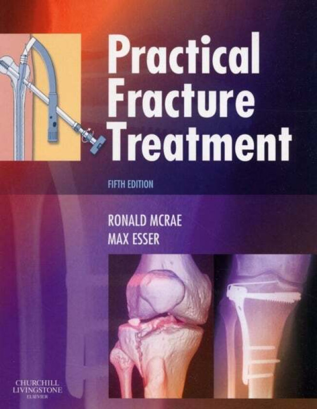 Practical Fracture Treatment av Ronald (Formerly Consultant Orthopaedic Surgeon Southern General Hospital Glasgow UK) McRae, Max (Orthopaedic Surgeon