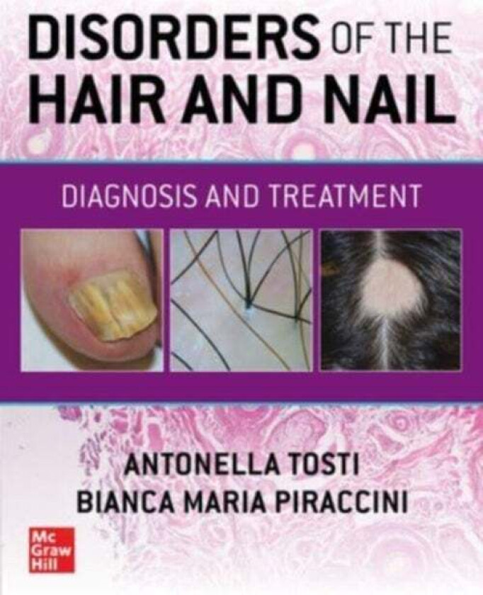 Disorders of the Hair and Nail: Diagnosis and Treatment av Antonella Tosti, Bianca Maria Piraccini