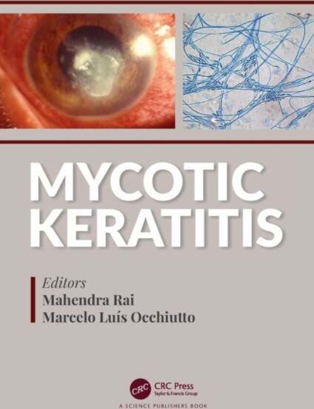 Mycotic Keratitis