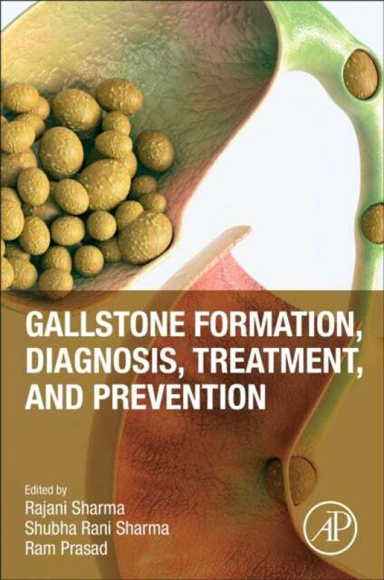 Gallstone Formation, Diagnosis, Treatment And Prevention
