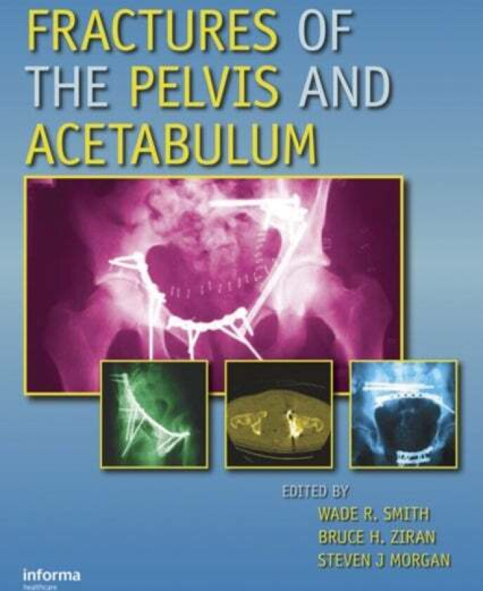 Fractures of the Pelvis and Acetabulum
