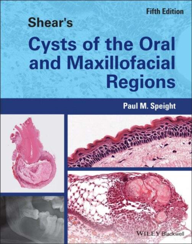Shear's Cysts of the Oral and Maxillofacial Regions av Paul M. (School of Clinical Dentistry University of Sheffield UK) Speight
