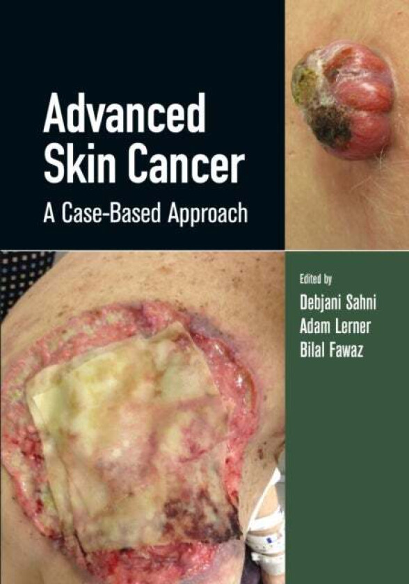 Advanced Skin Cancer