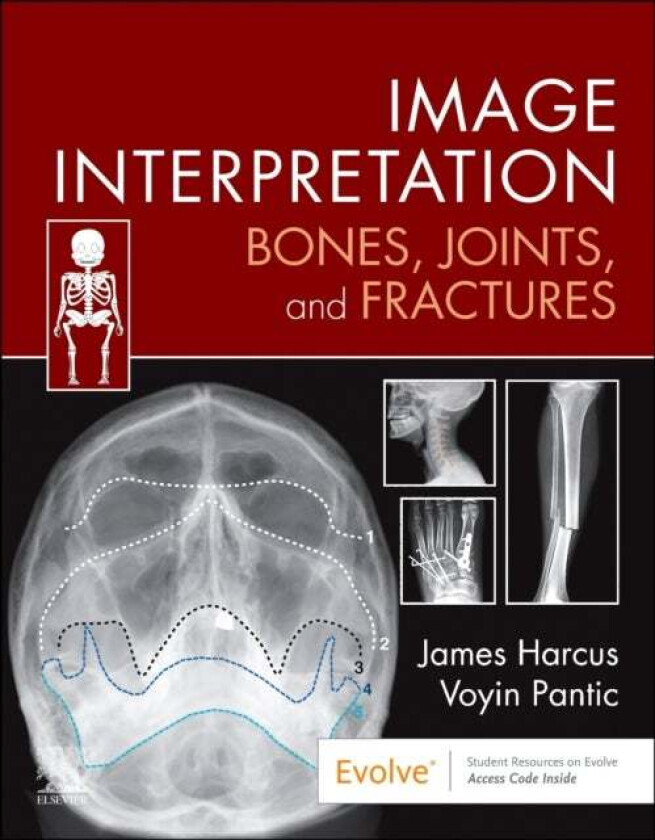Image Interpretation: Bones, Joints, and Fractures av James (Lecturer in Diagnostic Imaging University of Leeds UK) Harcus, Voyin Pantic