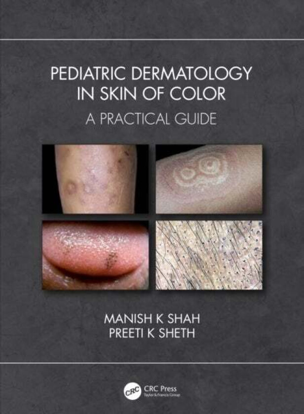Pediatric Dermatology in Skin of Color av Manish K (Bai Jerbai Hospital for Children Shah