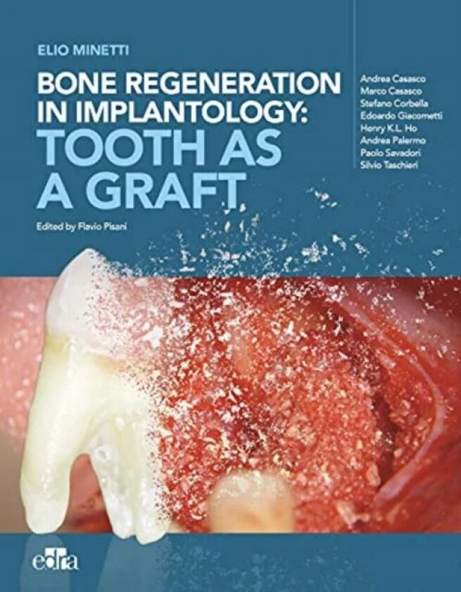 Bone regeneration in implantology - tooth as a graft av Elio Minetti, Andrea Cusasco, Marco Casasco, Co