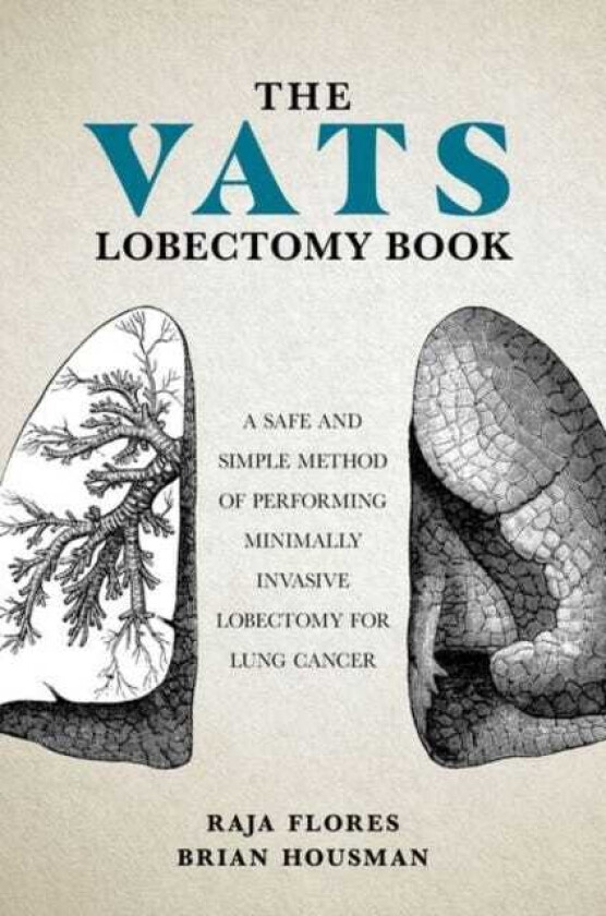 The VATS Lobectomy Book A Safe and Simple Method of Performing Minimally Invasive Lobectomy for Lung Cancer