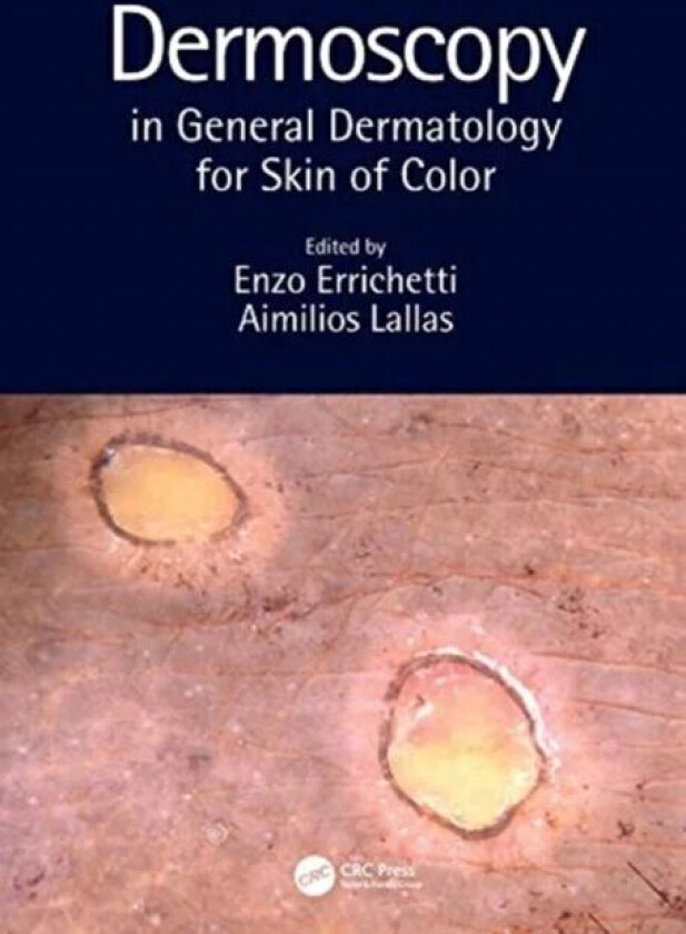 Dermoscopy in General Dermatology for Skin of Color
