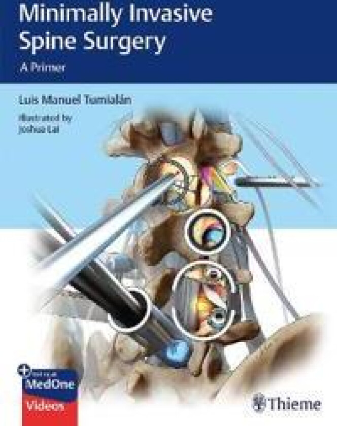 Minimally Invasive Spine Surgery