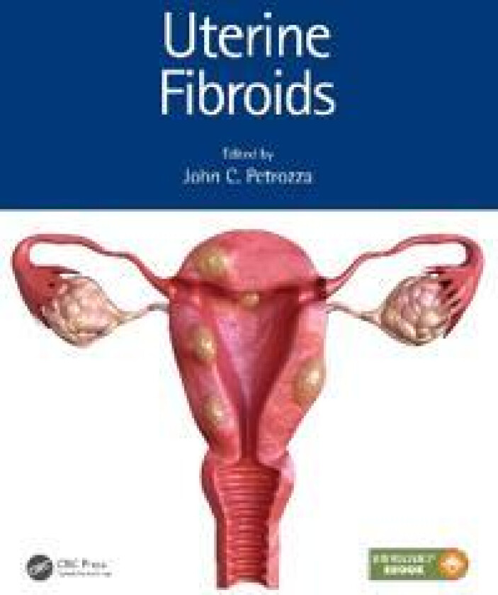 Uterine Fibroids