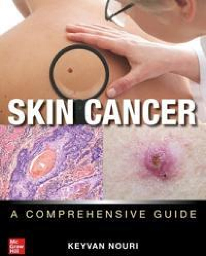 Skin Cancer: A Comprehensive Guide