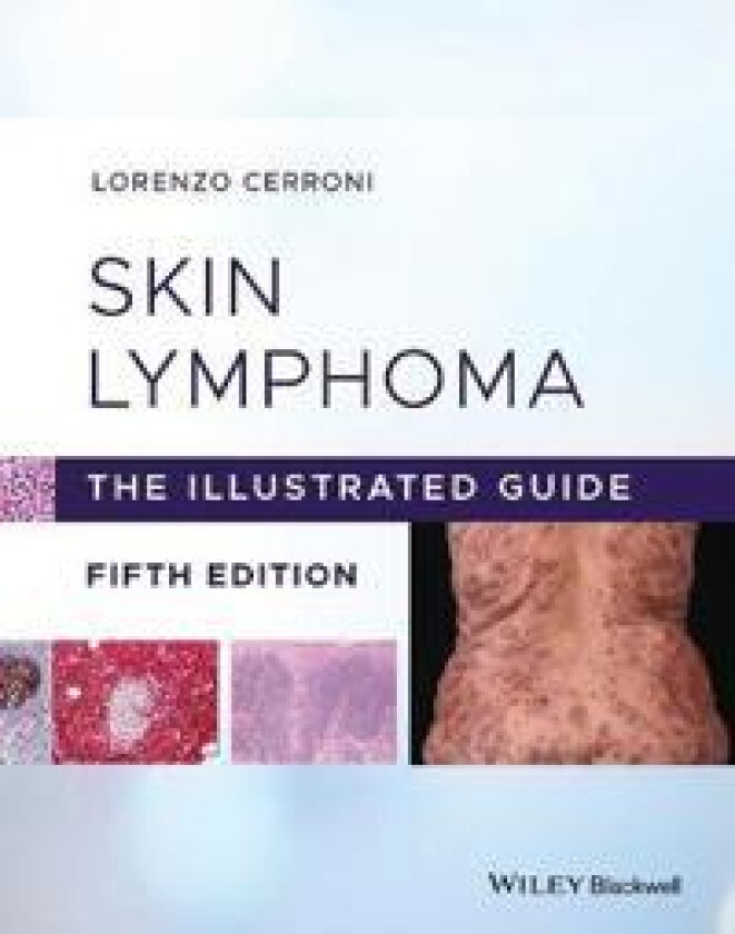 Skin Lymphoma