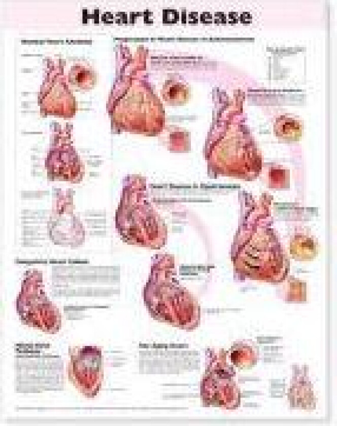 Heart Disease Anatomical Chart