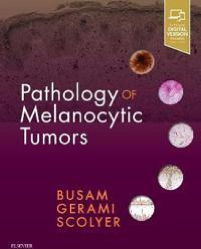 Pathology of Melanocytic Tumors