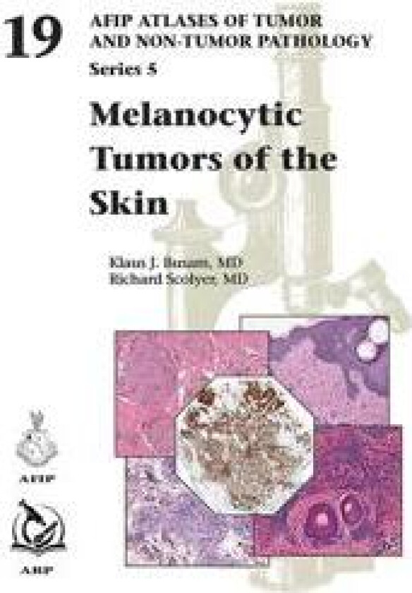 Melanocytic Tumors of the Skin