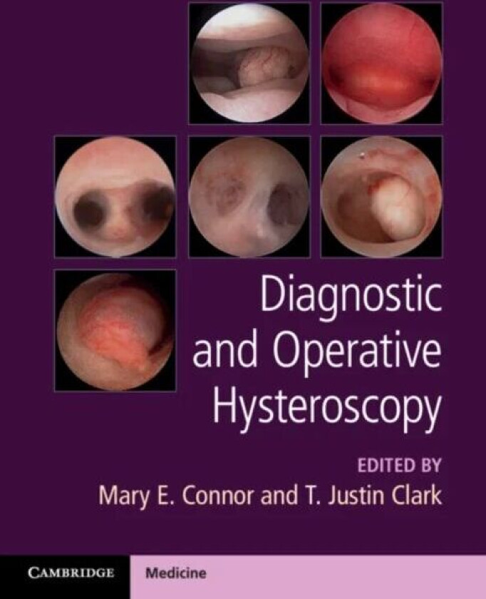 Diagnostic and Operative Hysteroscopy