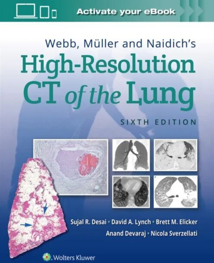 Webb, Muller and Naidich's High-Resolution CT of the Lung av Sujal Desai, David Lynch, Brett M MD Elicker, Anand Devaraj, Nicola Sverzellati