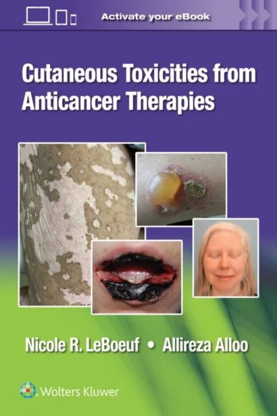 Cutaneous Toxicities from Anticancer Therapies av Dr. Nicole LeBeouf, Dr. Allireza Alloo