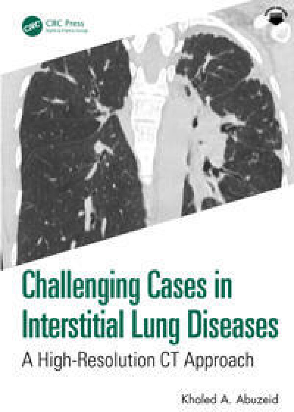 Challenging Cases in Interstitial Lung Diseases