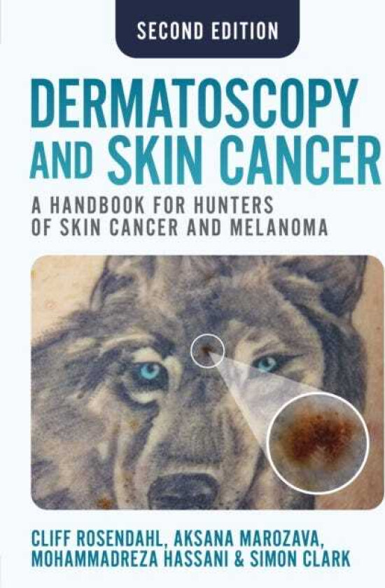Dermatoscopy and Skin Cancer, second edition A handbook for hunters of skin cancer and melanoma