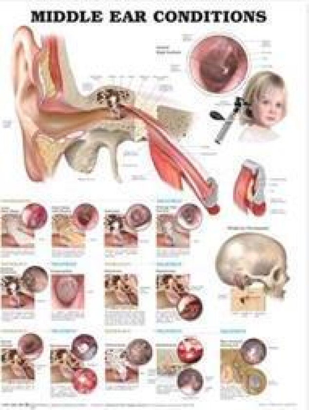 Middle Ear Conditions Anatomical Chart