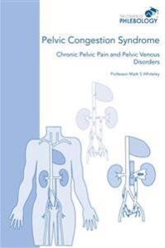 Pelvic Congestion Syndrome - Chronic Pelvic Pain and Pelvic Venous Disorders