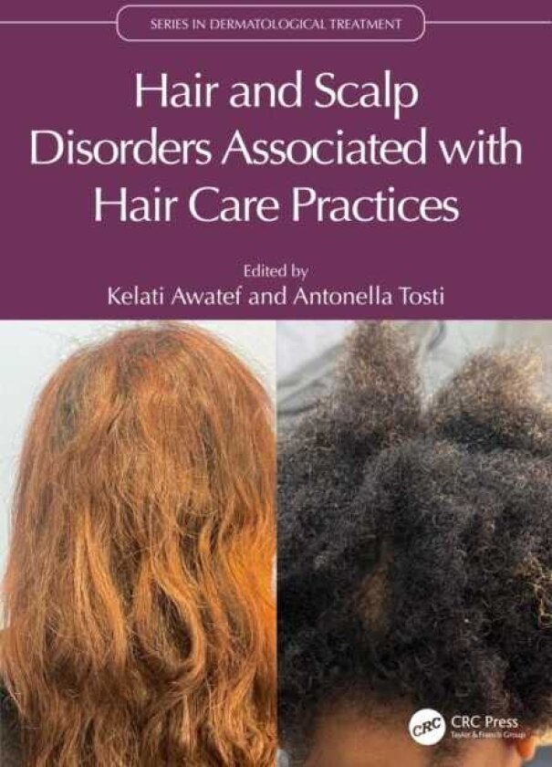 Hair and Scalp Disorders Associated with Hair Care Practices
